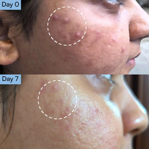 Acne Relief Serum