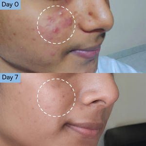 Acne Control Face Wash