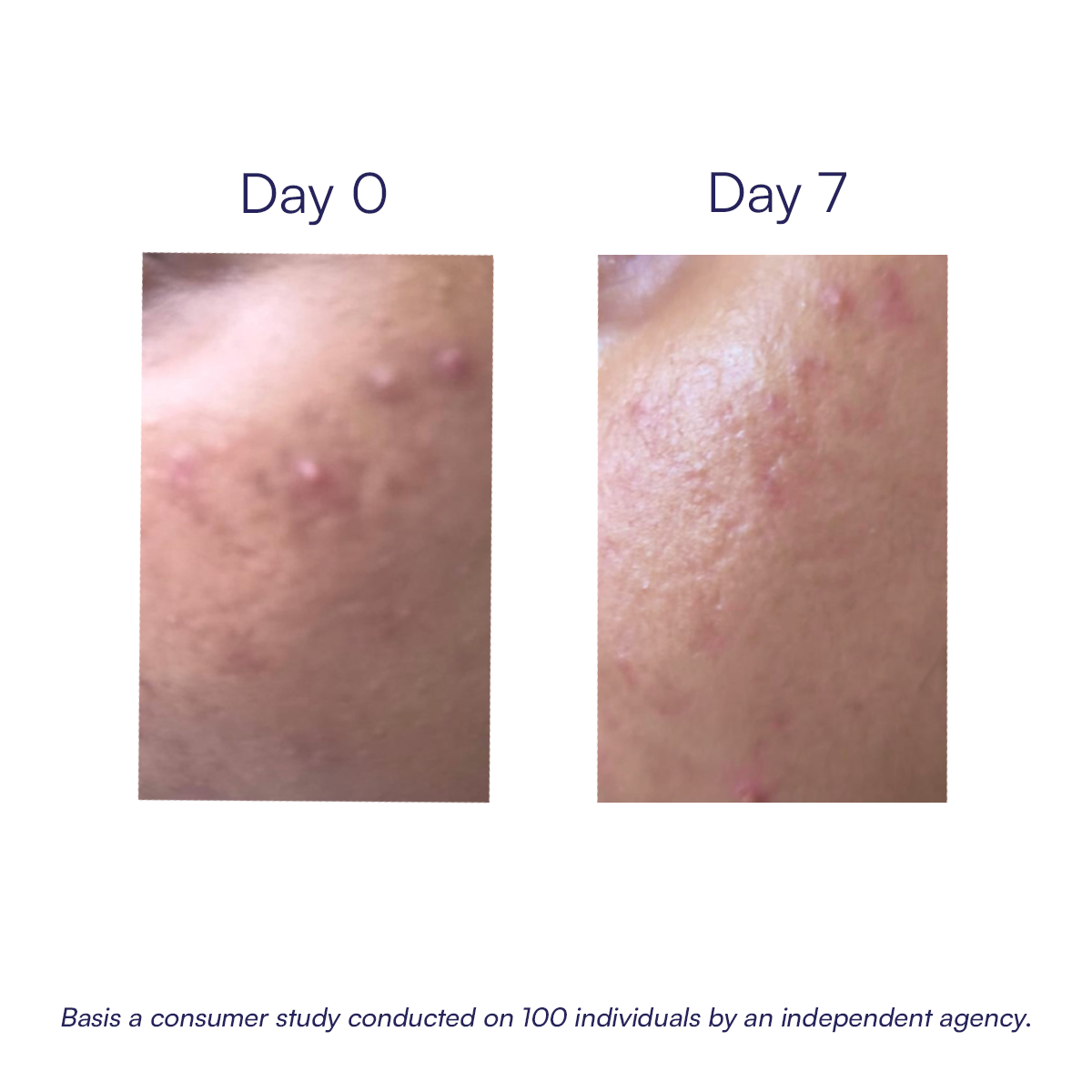 Acne Control Face Wash | 100 ml