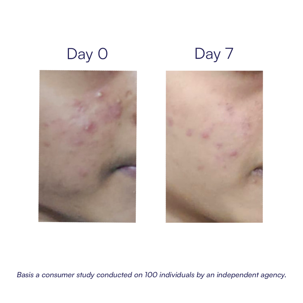 Acne Relief Serum | 30 ml