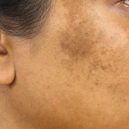 PIGMENTATION