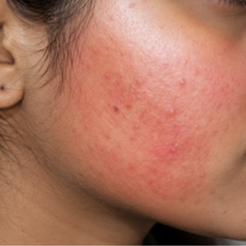 REDNESS & IRRITATION